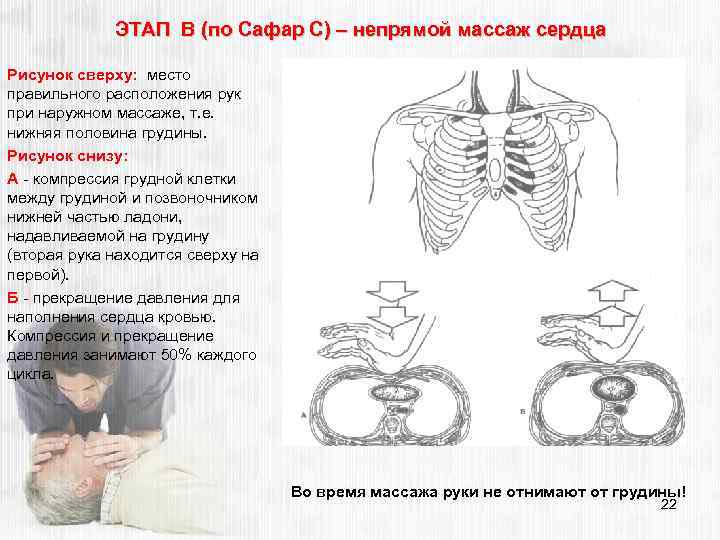 ЭТАП В (по Сафар С) – непрямой массаж сердца Рисунок сверху: место правильного расположения