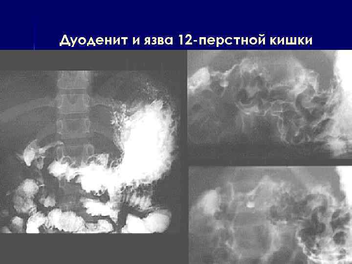 Дуоденит и язва 12 -перстной кишки 