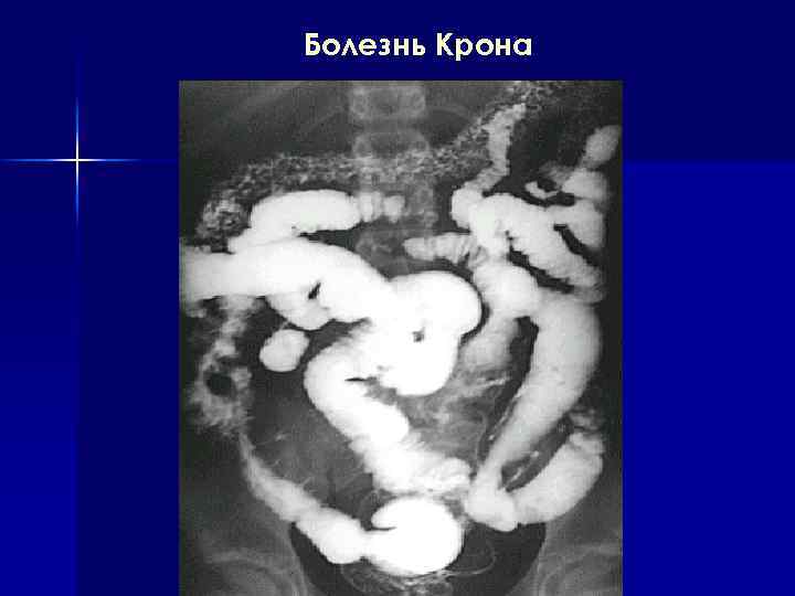 Болезнь Крона 