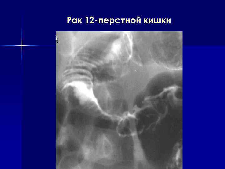 Рак 12 -перстной кишки 