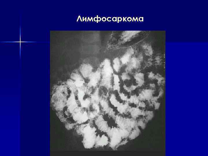 Лимфосаркома 