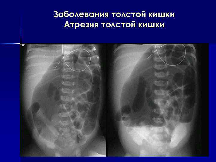 Заболевания толстой кишки Атрезия толстой кишки 