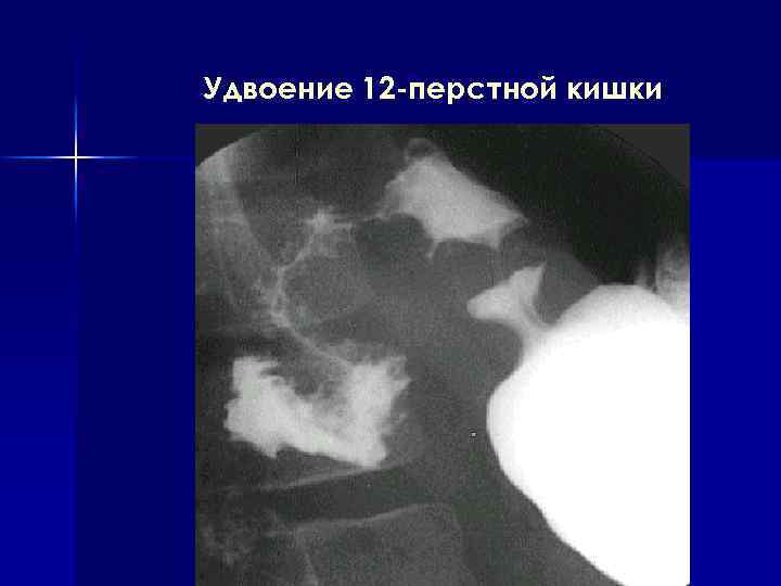 Удвоение 12 -перстной кишки 