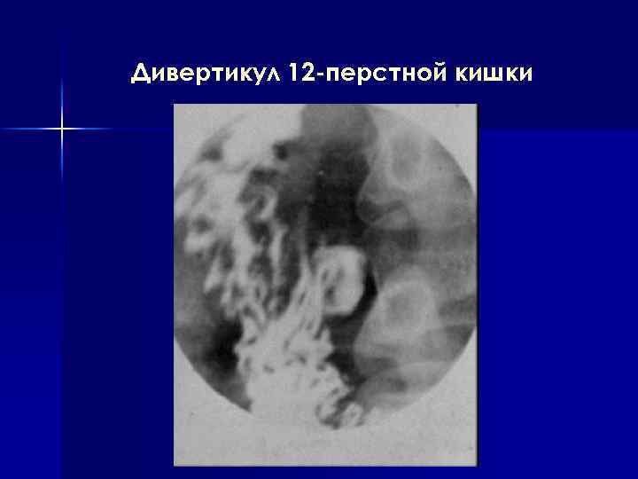 Дивертикул 12 -перстной кишки 