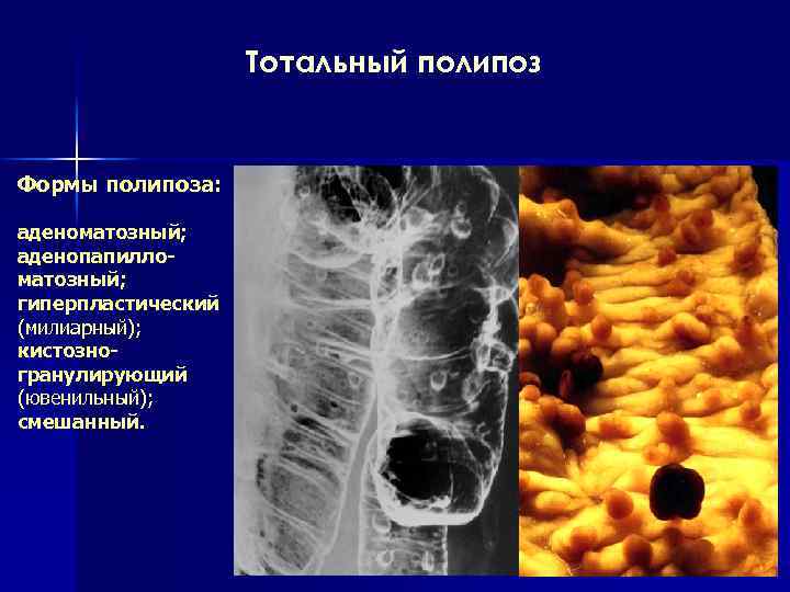 Тотальный полипоз Формы полипоза: аденоматозный; аденопапилломатозный; гиперпластический (милиарный); кистозногранулирующий (ювенильный); смешанный. 
