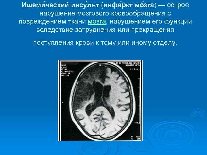 Ишеми ческий инсу льт (инфа ркт мо зга) — острое нарушение мозгового кровообращения с