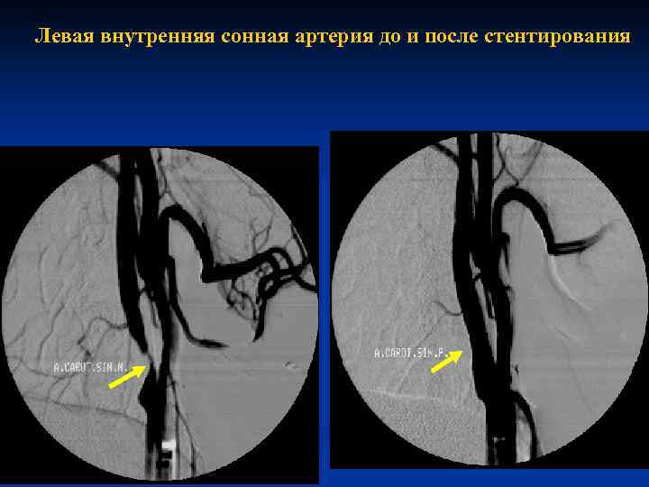 Левая внутренняя сонная артерия до и после стентирования 