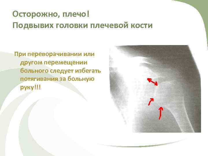 Осторожно, плечо! Подвывих головки плечевой кости При переворачивании или другом перемещении больного следует избегать