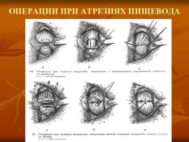 ОПЕРАЦИИ ПРИ АТРЕЗИЯХ ПИЩЕВОДА 