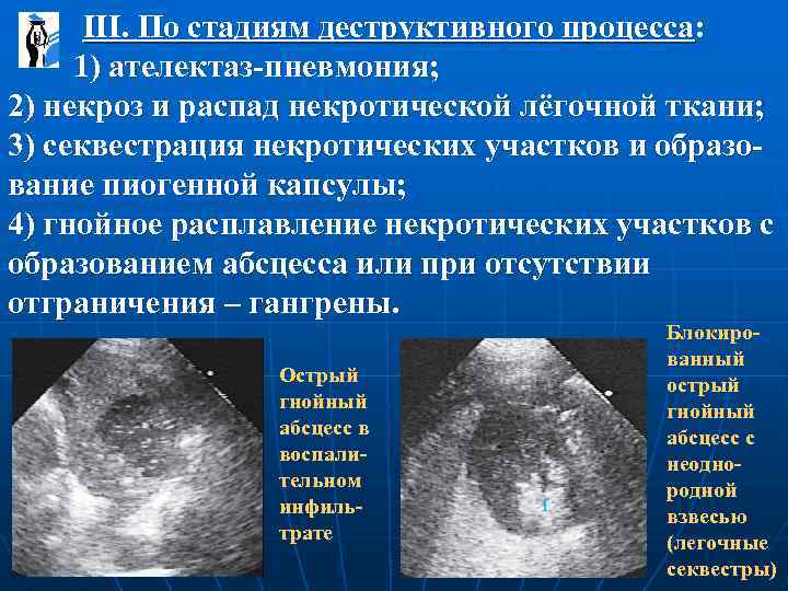 III. По стадиям деструктивного процесса: 1) ателектаз-пневмония; 2) некроз и распад некротической лёгочной ткани;