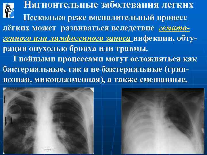  Нагноительные заболевания легких Несколько реже воспалительный процесс лёгких может развиваться вследствие гематогенного или