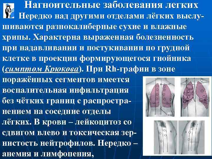  Нагноительные заболевания легких Нередко над другими отделами лёгких выслу- шиваются разнокалиберные сухие и