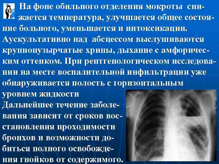  На фоне обильного отделения мокроты сни- жается температура, улучшается общее состояние больного, уменьшается