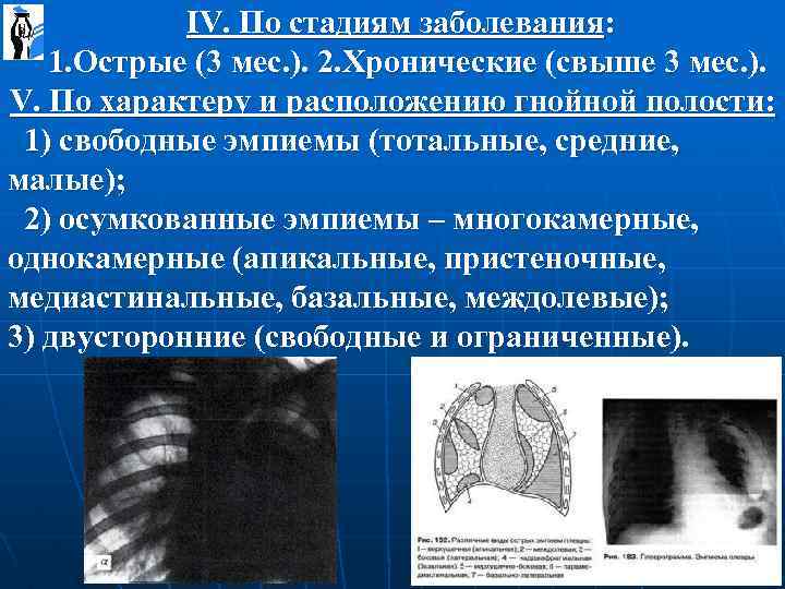  IV. По стадиям заболевания: 1. Острые (3 мес. ). 2. Хронические (свыше 3