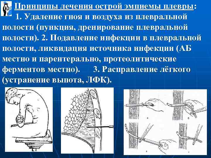 Принципы лечения острой эмпиемы плевры: 1. Удаление гноя и воздуха из плевральной полости (пункция,