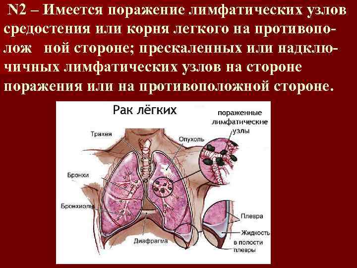 N 2 – Имеется поражение лимфатических узлов средостения или корня легкого на противополож ной