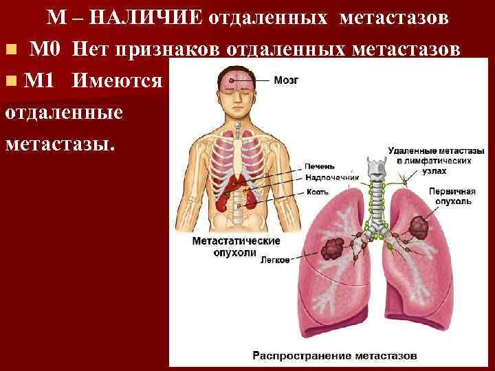 М – НАЛИЧИЕ отдаленных метастазов n М 0 Нет признаков отдаленных метастазов n М