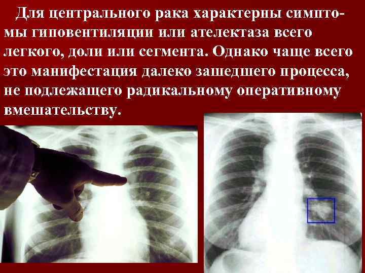 Для центрального рака характерны симптомы гиповентиляции или ателектаза всего легкого, доли или сегмента. Однако