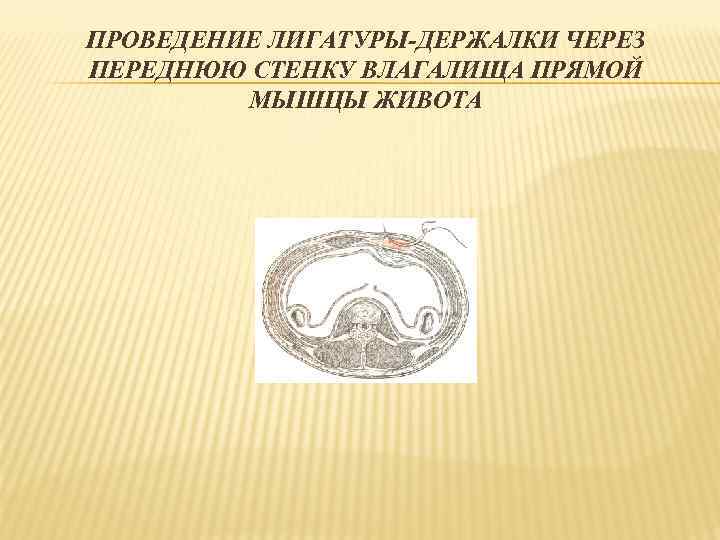 ПРОВЕДЕНИЕ ЛИГАТУРЫ-ДЕРЖАЛКИ ЧЕРЕЗ ПЕРЕДНЮЮ СТЕНКУ ВЛАГАЛИЩА ПРЯМОЙ МЫШЦЫ ЖИВОТА 