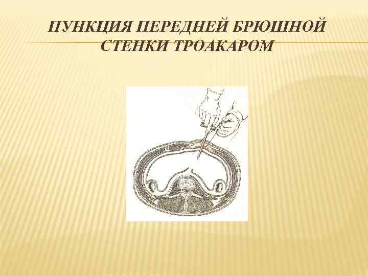ПУНКЦИЯ ПЕРЕДНЕЙ БРЮШНОЙ СТЕНКИ ТРОАКАРОМ 