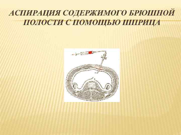 АСПИРАЦИЯ СОДЕРЖИМОГО БРЮШНОЙ ПОЛОСТИ С ПОМОЩЬЮ ШПРИЦА 