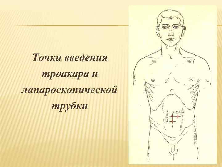 Точки введения троакара и лапароскопической трубки 