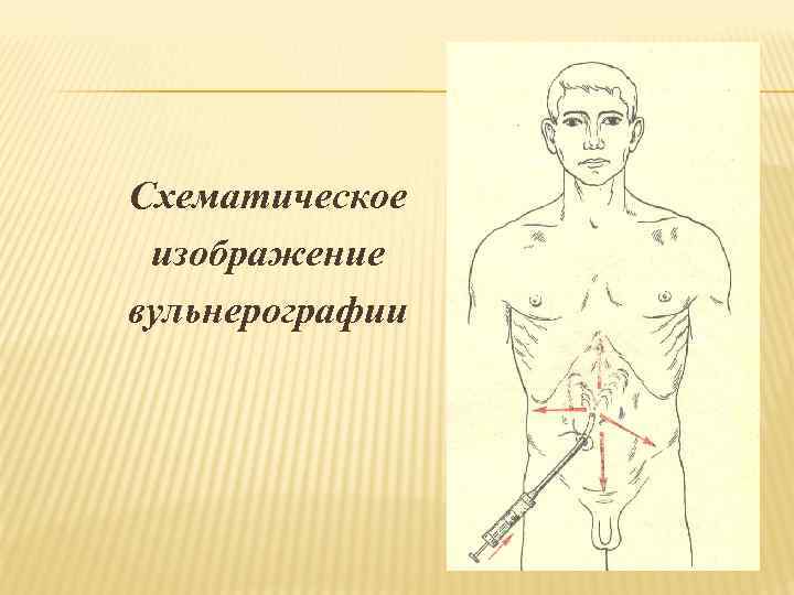 Схематическое изображение вульнерографии 