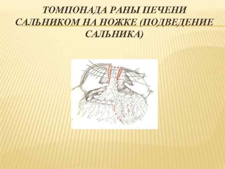 ТОМПОНАДА РАНЫ ПЕЧЕНИ САЛЬНИКОМ НА НОЖКЕ (ПОДВЕДЕНИЕ САЛЬНИКА) 
