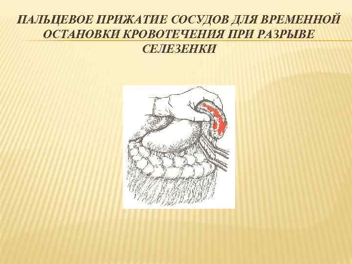 ПАЛЬЦЕВОЕ ПРИЖАТИЕ СОСУДОВ ДЛЯ ВРЕМЕННОЙ ОСТАНОВКИ КРОВОТЕЧЕНИЯ ПРИ РАЗРЫВЕ СЕЛЕЗЕНКИ 