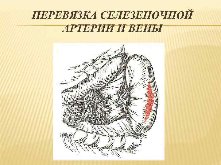 ПЕРЕВЯЗКА СЕЛЕЗЕНОЧНОЙ АРТЕРИИ И ВЕНЫ 