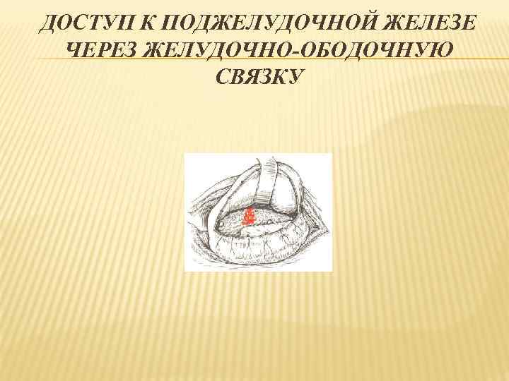 ДОСТУП К ПОДЖЕЛУДОЧНОЙ ЖЕЛЕЗЕ ЧЕРЕЗ ЖЕЛУДОЧНО-ОБОДОЧНУЮ СВЯЗКУ 