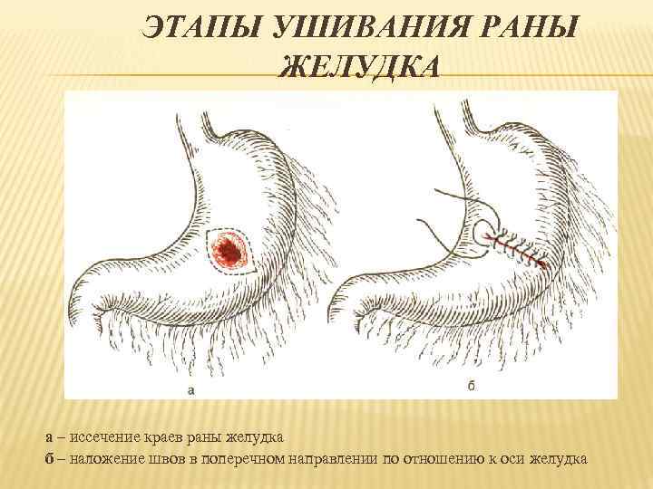 ЭТАПЫ УШИВАНИЯ РАНЫ ЖЕЛУДКА а – иссечение краев раны желудка б – наложение швов