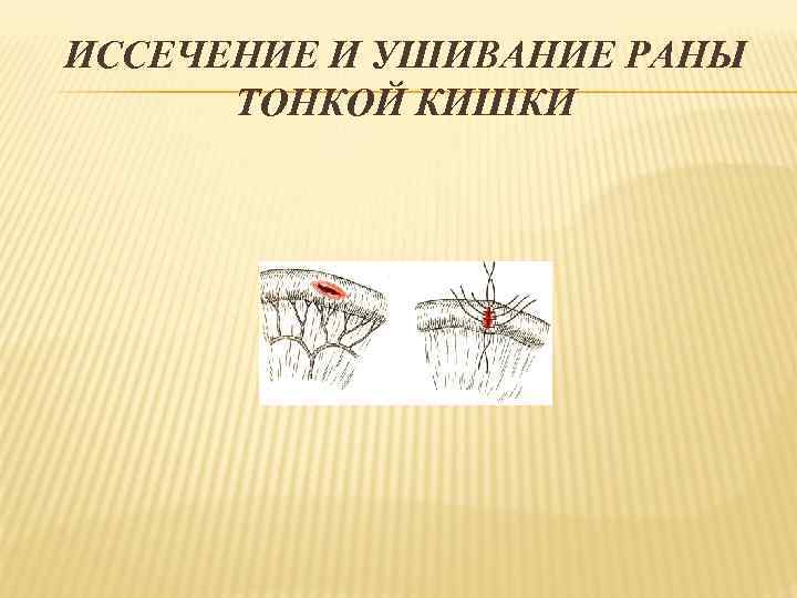 ИССЕЧЕНИЕ И УШИВАНИЕ РАНЫ ТОНКОЙ КИШКИ 