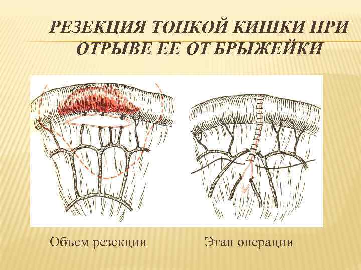 РЕЗЕКЦИЯ ТОНКОЙ КИШКИ ПРИ ОТРЫВЕ ЕЕ ОТ БРЫЖЕЙКИ Объем резекции Этап операции 