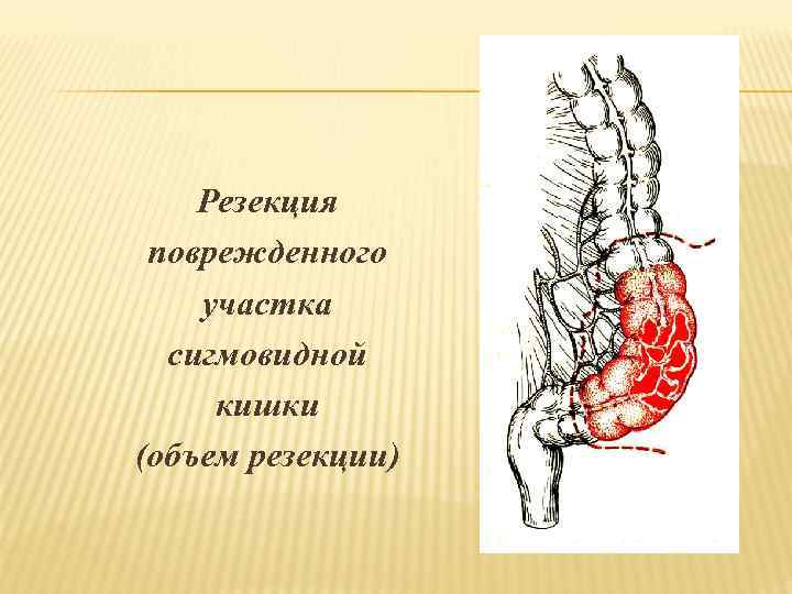 Резекция поврежденного участка сигмовидной кишки (объем резекции) 