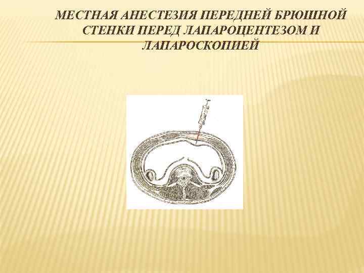 МЕСТНАЯ АНЕСТЕЗИЯ ПЕРЕДНЕЙ БРЮШНОЙ СТЕНКИ ПЕРЕД ЛАПАРОЦЕНТЕЗОМ И ЛАПАРОСКОПИЕЙ 