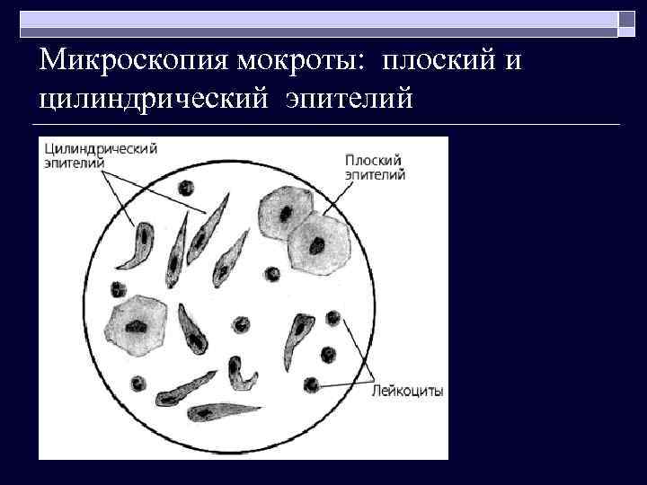 Микроскопия мокроты: плоский и цилиндрический эпителий 