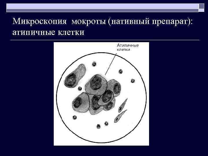 Микроскопия мокроты (нативный препарат): атипичные клетки 