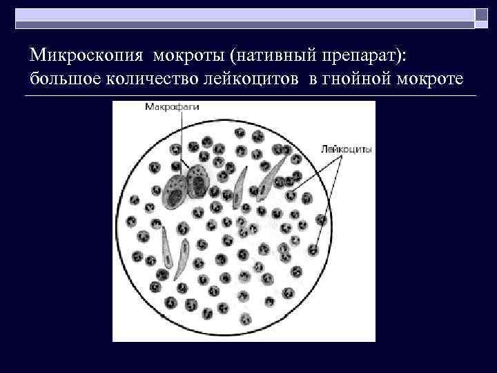 Микроскопия мокроты (нативный препарат): большое количество лейкоцитов в гнойной мокроте 