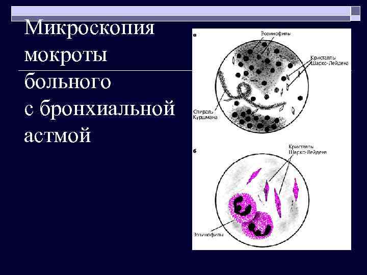 Микроскопия мокроты больного с бронхиальной астмой 