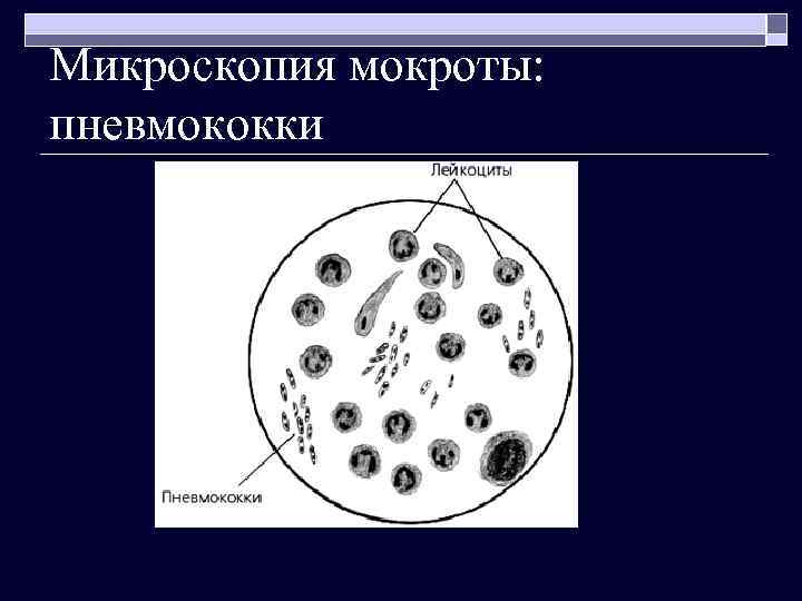 Микроскопия мокроты: пневмококки 