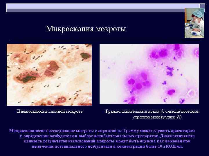 Микроскопия мокроты Пневмококки в гнойной мокроте Грамположительные кокки (b-гемолитические стрептококки группы А) Микроскопическое исследование