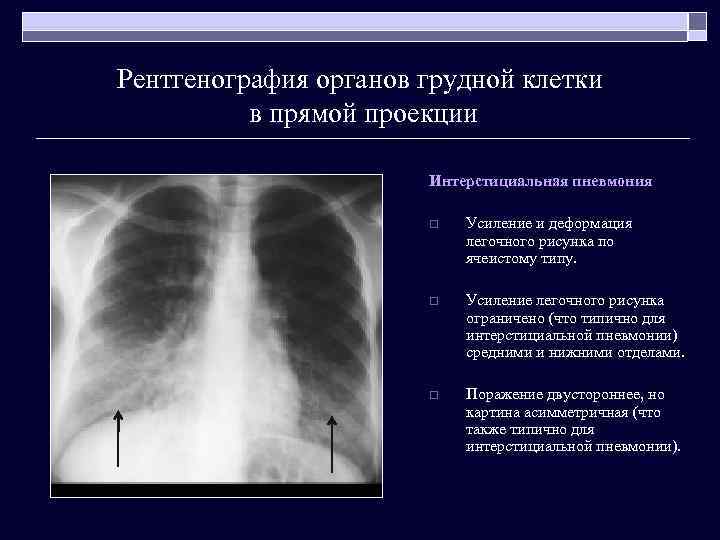 Рентгенография органов грудной клетки в прямой проекции Интерстициальная пневмония o Усиление и деформация легочного