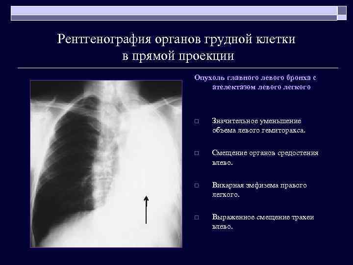 Рентгенография органов грудной клетки в прямой проекции Опухоль главного левого бронха с ателектазом левого