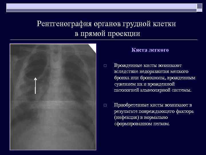 Рентгенография органов грудной клетки в прямой проекции Киста легкого o Врожденные кисты возникают вследствие