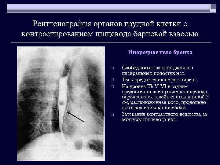 Рентгенография органов грудной клетки с контрастированием пищевода бариевой взвесью Инородное тело бронха o o