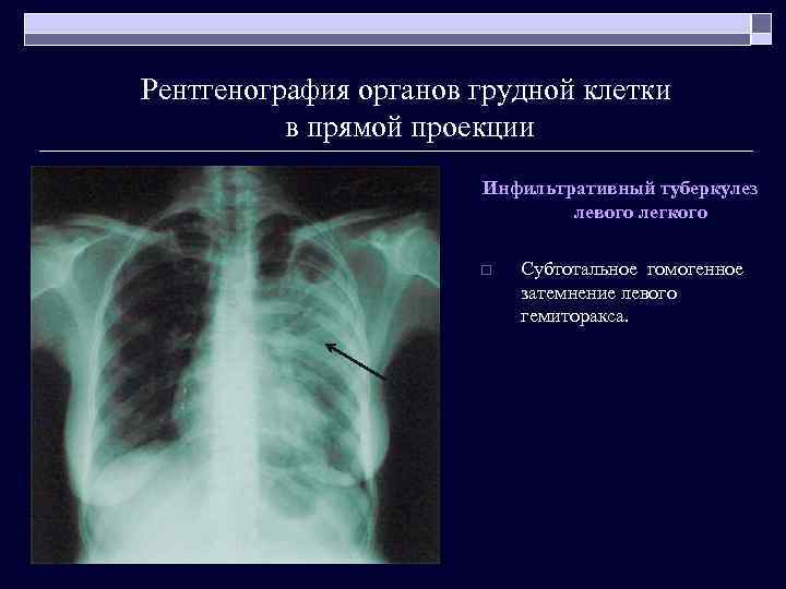 Рентгенография органов грудной клетки в прямой проекции Инфильтративный туберкулез левого легкого o Субтотальное гомогенное