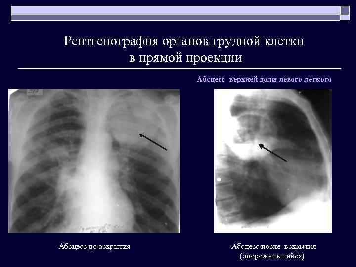 Рентгенография органов грудной клетки в прямой проекции Абсцесс верхней доли левого легкого Абсцесс до