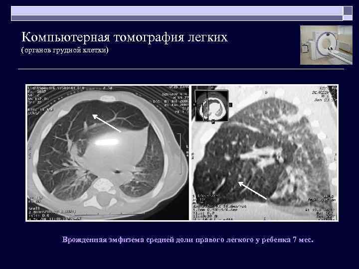 Компьютерная томография легких (органов грудной клетки) Врожденная эмфизема средней доли правого легкого у ребенка