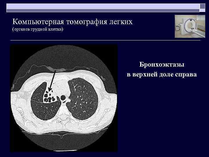 Компьютерная томография легких (органов грудной клетки) Бронхоэктазы в верхней доле справа 